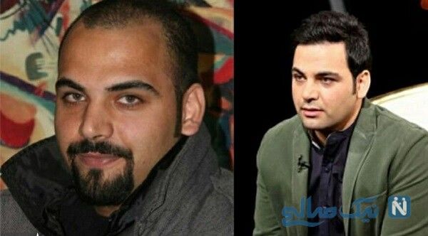احسان علیخانی قبل و بعد از کاشت مو +عکس
