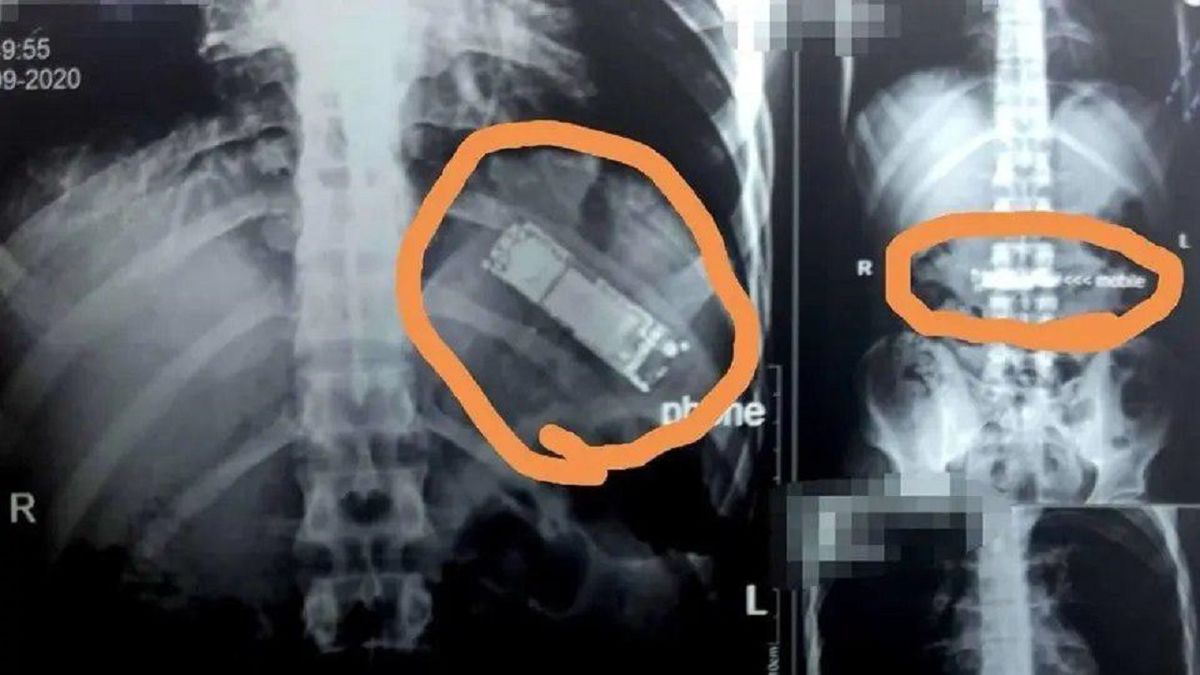 نجات بیمار مصری از خطر انفجار معده! + عکس 